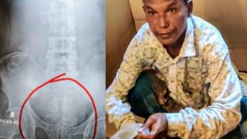 পেটে ইয়াবা নিয়ে টেকনাফ থেকে বগুড়া গিয়ে ধরা আলম